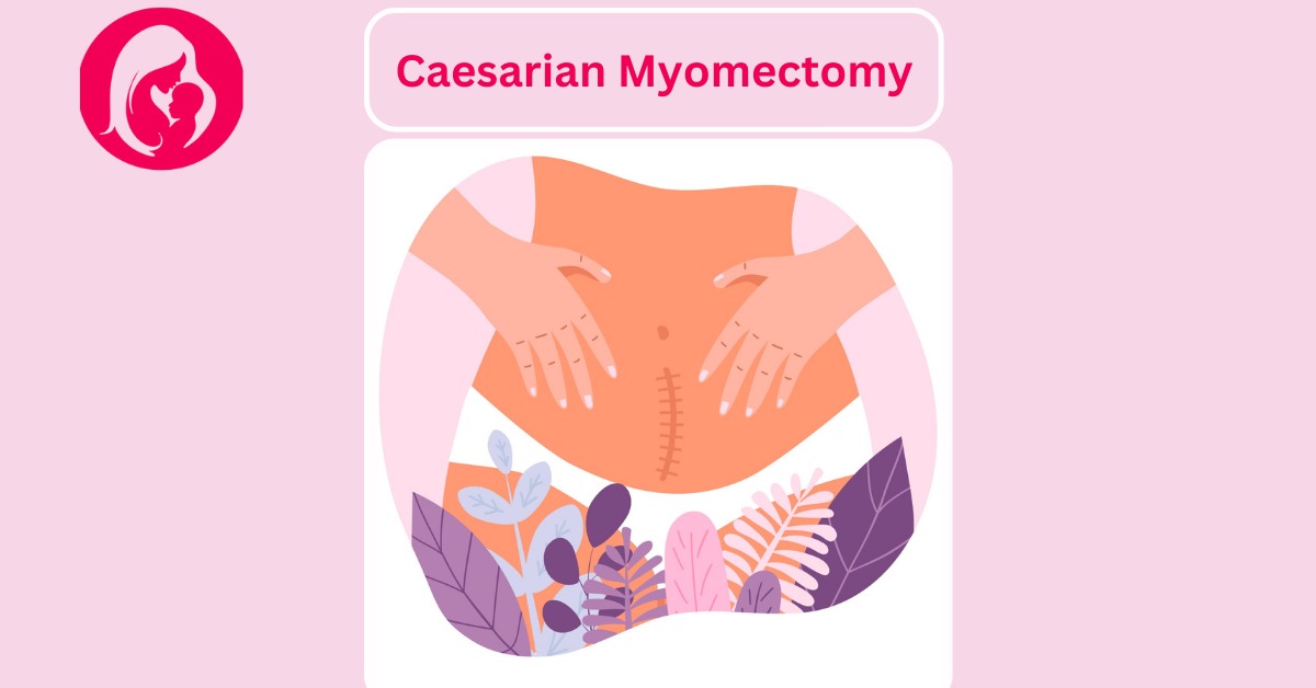 Caesarian Myomectomy surgery indore