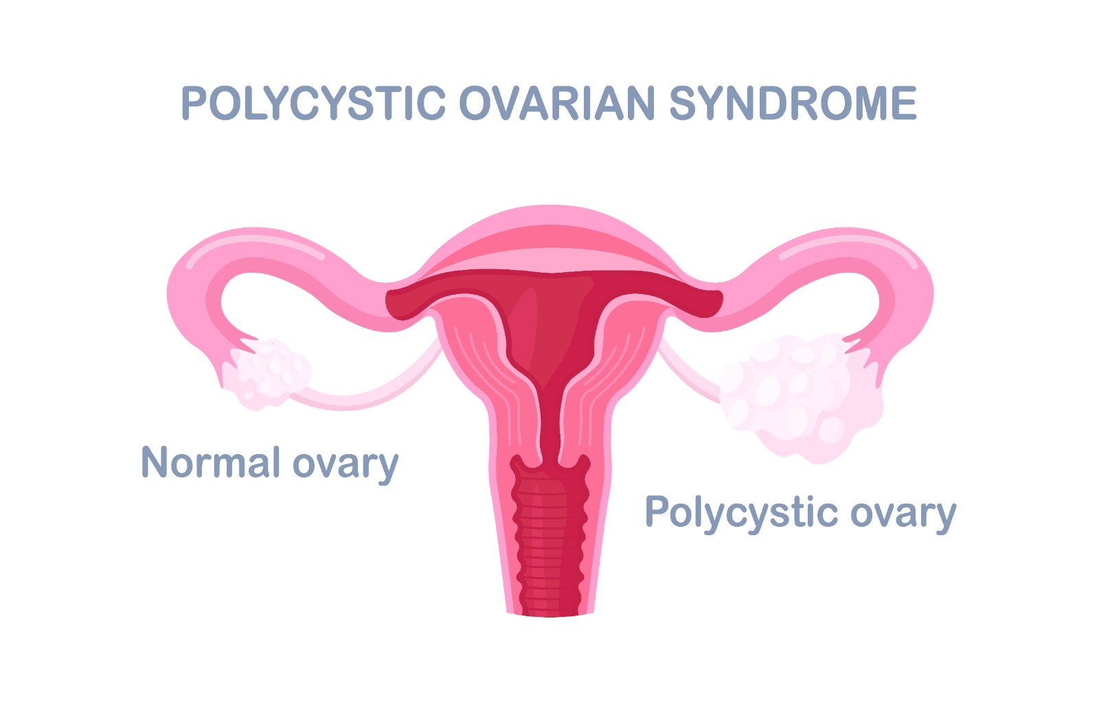 pcos treatment in indore