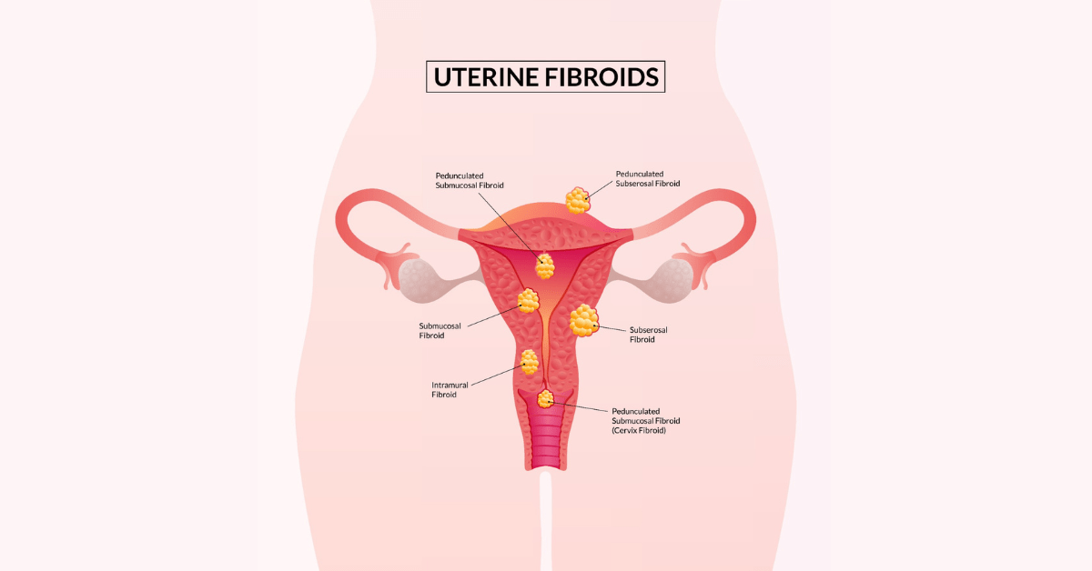 fibroid surgery indore.