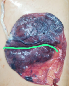Rare High-Risk Pregnancy Successfully Managed with Timely Emergency C-Section
