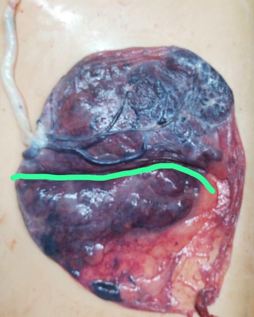 Rare High-Risk Pregnancy Successfully Managed with Timely Emergency C-Section