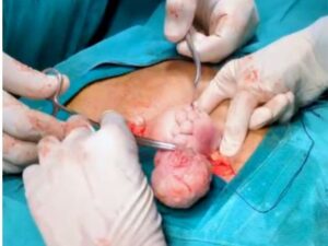Large Uterine Fibroid Successfully Removed with Fertility-Preserving Myomectomy in a 34-Year-Old Woman