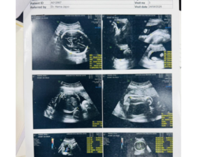 Successful Pregnancy Outcome in a Fetus with CPAM: Close Monitoring Leads to Healthy Delivery
