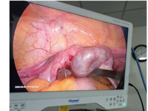 8 Years of Primary Infertility — A Diagnosis Revealed by Laparoscopy
